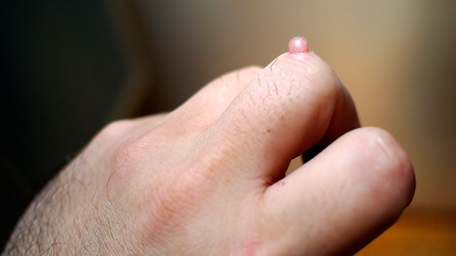 Image for Why Do Warts Appear and How to Treat Them? with ID of: 4392736