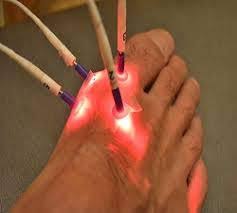 Image for Carbon Source Laser Acupuncture Market Status & Supply Demand | Industry Forecast Report To, 2025 with ID of: 4621036