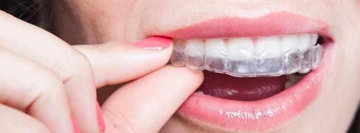 Image for Braces Brooklyn with ID of: 4623362