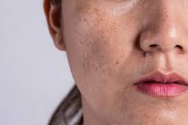 Image for Hyperpigmentation Treatment Market 2021 Future Estimations, Drivers and Growth Opportunities Till 2026 with ID of: 4730690