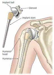 Image for Global Shoulder Implants Market Share is Expected To Get Massive Growth Profits by 2026 with ID of: 4820506
