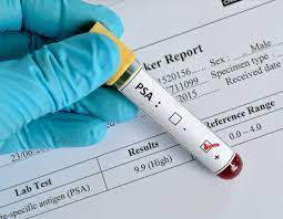 Image for PSA Test Market Size, Demand, Growth And Industry Development Trends By 2021-2026 with ID of: 4842251
