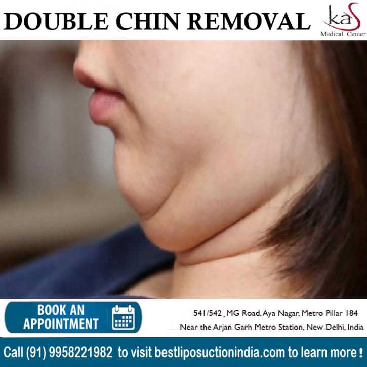 Image for Get the Best Double Chin Removal Surgery in India at KAS Medical Center with ID of: 4879832