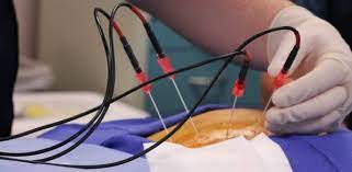 Image for Global Ablation Technologies Market Share is Expected To Get Massive Growth Profits by 2026 with ID of: 4890518