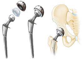 Image for Global Joint Replacement Implants Market Share is Expected To Get Massive Growth Profits by 2026 with ID of: 4972796