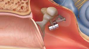 Image for Middle Ear Implants Market Share is Expected To Get Massive Growth Profits by 2026 with ID of: 5054177