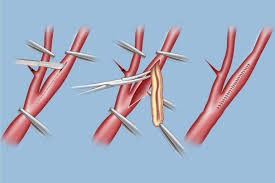 Image for Vascular Patches Market Share is Expected To Get Massive Growth Profits by 2026 with ID of: 5082685