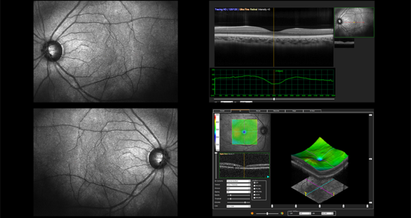 Image for Global Optical Coherence Tomography Market Emerging Trends And Growth Analysis Report 2021-2027 with ID of: 5090155