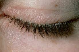 Image for Blepharitis Market Share is Expected To Get Massive Growth Profits by 2028 with ID of: 5157245