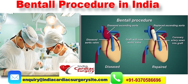 Image for Bentall Surgery with ID of: 5216600