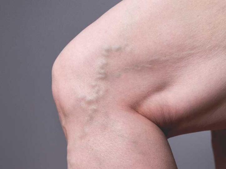 Image for 5 Unexpected Risks for Deep Vein Thrombosis with ID of: 5246723