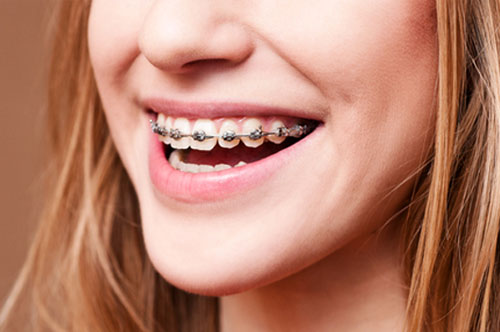 Image for 4 Best Ways to Fix Gaps Between Teeth with ID of: 5345195