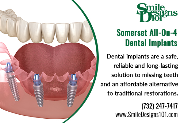 Image for All on Four dental implants somerset with ID of: 5355704