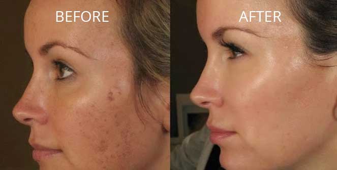 Image for microneedling twickenham with ID of: 5416694
