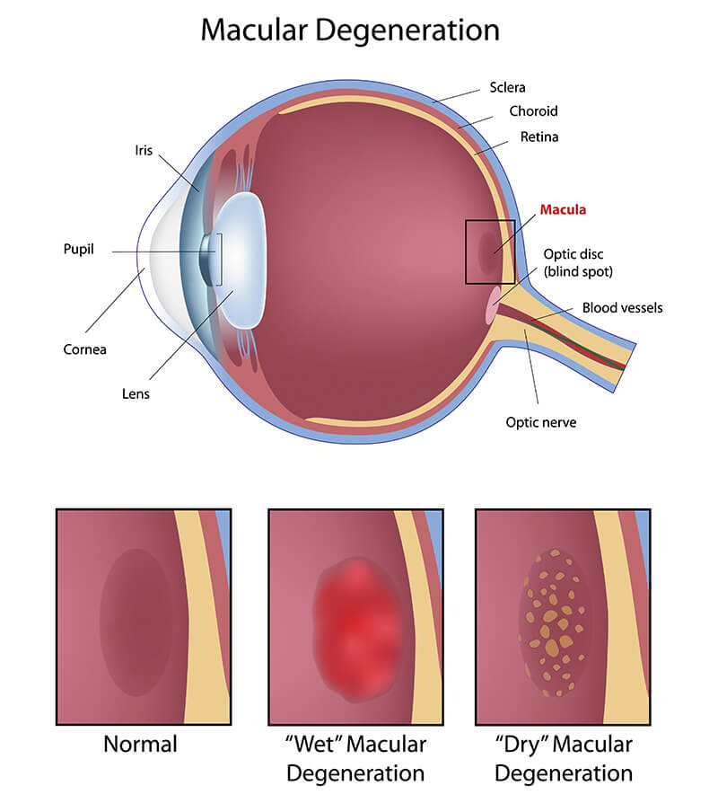 Image for Macular Degeneration : How Stem Cell Therapy is Transforming Lives in India with ID of: 5557085