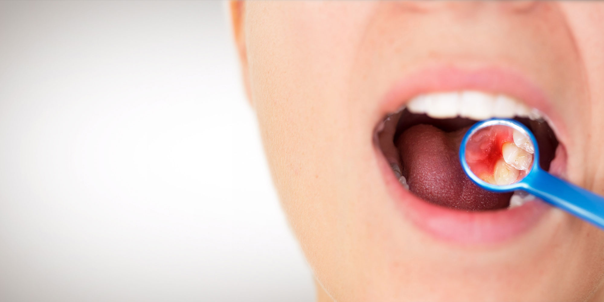 Image for Everything You Should Know About Gum Disease with ID of: 5598129