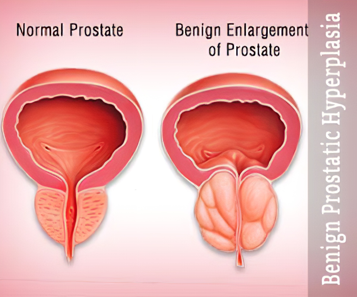 Image for Benign Prostate Hyperplasia (BPH) Treatment Market 2018-2028: Trends, Opportunities, and Forecasts | Techsci Research with ID of: 5640807