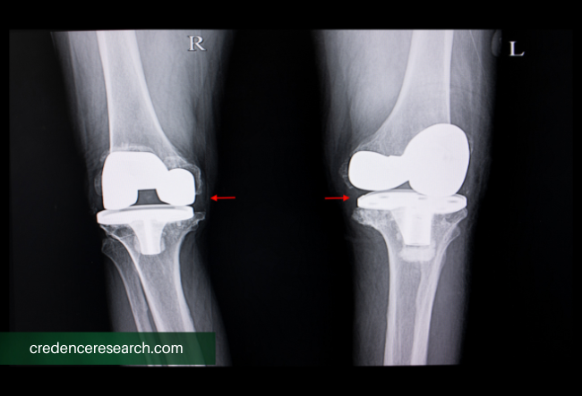 Image for Cementless Total Knee Arthroplasty Market Is Expected To Generate A Revenue Of USD 2923.5 million By 2030 with ID of: 5817975