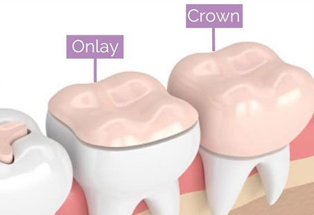 Image for Six Common Problems With Dental Fillings with ID of: 5933285