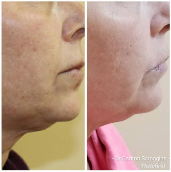 Image for Dr. Carlton Scroggins Plastic Surgeon with ID of: 4720745