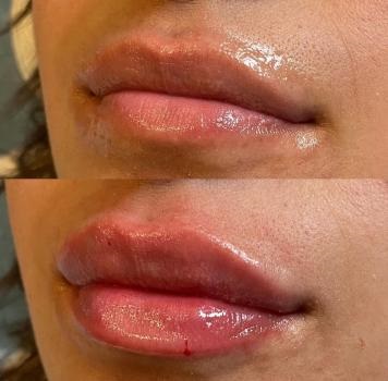 Image for Skinjectables Anti-Aging Bar with ID of: 4768027