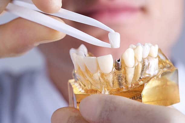 Image for Different Types of Dental Implants with ID of: 6096772