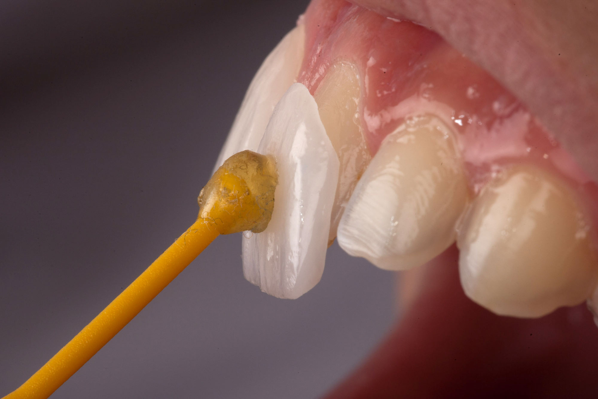 Image for The Magic or Science? How Veneers Are Designed to Look and Feel Like Real Teeth with ID of: 6261290