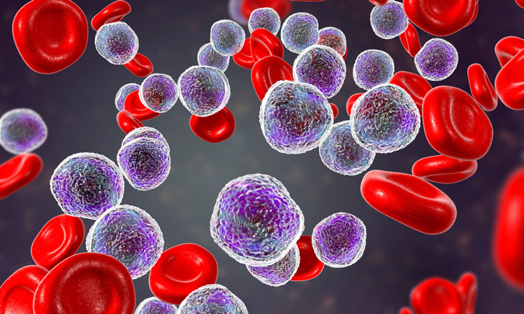 Image for Acute Lymphocytic Leukemia Therapeutics Market 2029: Surprising Facts and Future Projections Exposed with ID of: 6268835