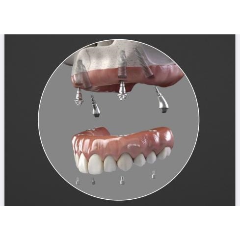Image for All-On-4 Dental Implants with ID of: 5256861
