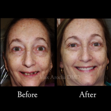 Image for All-On-4 Dental Implants with ID of: 5256862