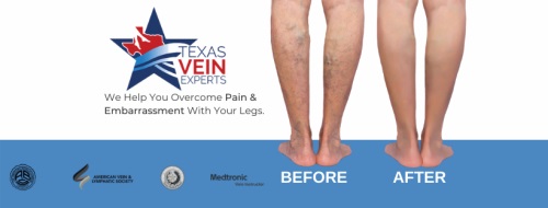 Image for Texas Vein Experts with ID of: 5521000