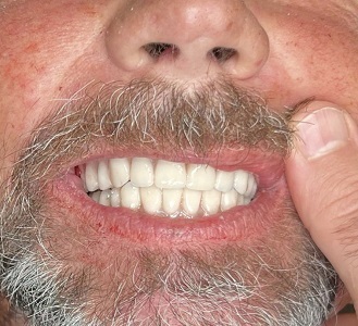 Image for Tampa Dental Implants with ID of: 5654496