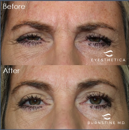 Image for Michael Burnstine, MD - Valencia Eyelid Surgery with ID of: 5655643