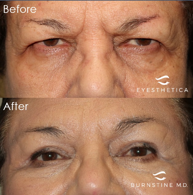 Image for Michael Burnstine, MD - Valencia Eyelid Surgery with ID of: 5655644