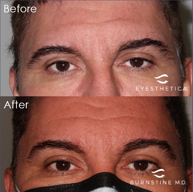 Image for Michael Burnstine, MD - Valencia Eyelid Surgery with ID of: 5655649