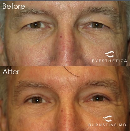 Image for Michael Burnstine, MD - Valencia Eyelid Surgery with ID of: 5655651