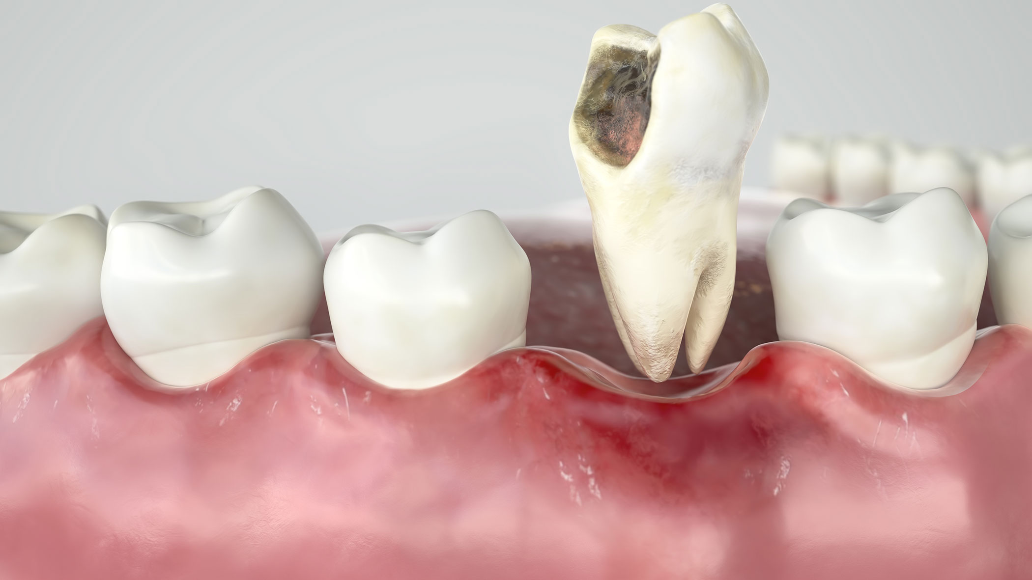 Image for 7 Cases in Which Tooth Extraction Is Required with ID of: 6558249