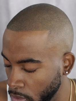 Image for Precision First SMP | Los Angeles Scalp Micropigmentation with ID of: 5895384