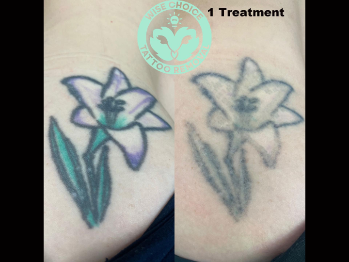 Image for Wise Choice Tattoo Removal with ID of: 5988653