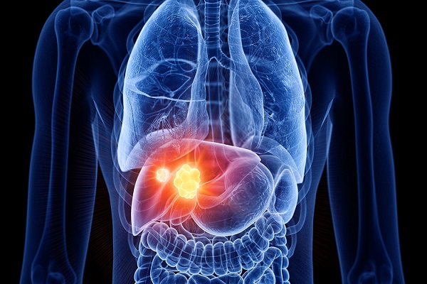 Image for Global Liver Fibrosis Drugs Market Size, Share, Growth 2032 with ID of: 6641638