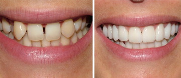 Image for How To Straighten Teeth Without Braces with ID of: 681697