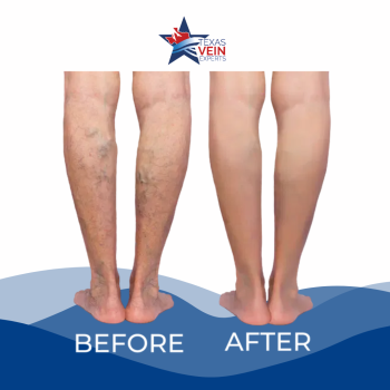 Image for Texas Vein Experts - Katy with ID of: 6497309