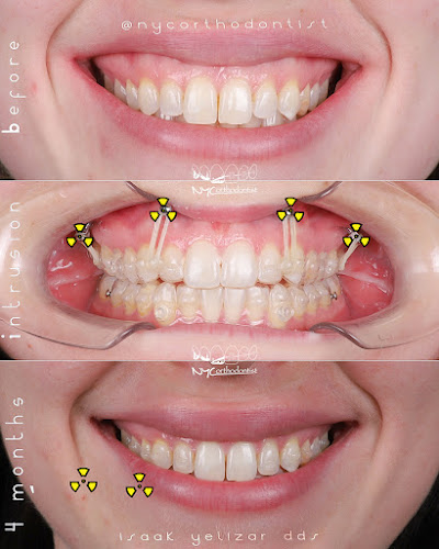 Image for SimpliBraces with ID of: 6541642