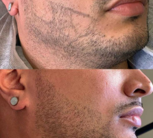 Image for Scalp Canvas - Scalp Micropigmentation Sydney with ID of: 6748990