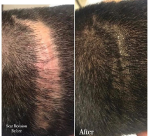 Image for Scalp Canvas - Scalp Micropigmentation Sydney with ID of: 6748992