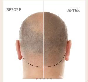 Image for Scalp Canvas - Scalp Micropigmentation Sydney with ID of: 6748993