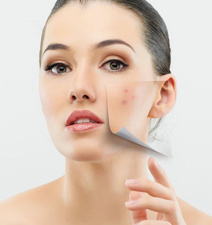 Image for Best Treatment for Acne Scars with ID of: 693372