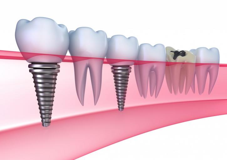 Image for Dental Implants with ID of: 693386