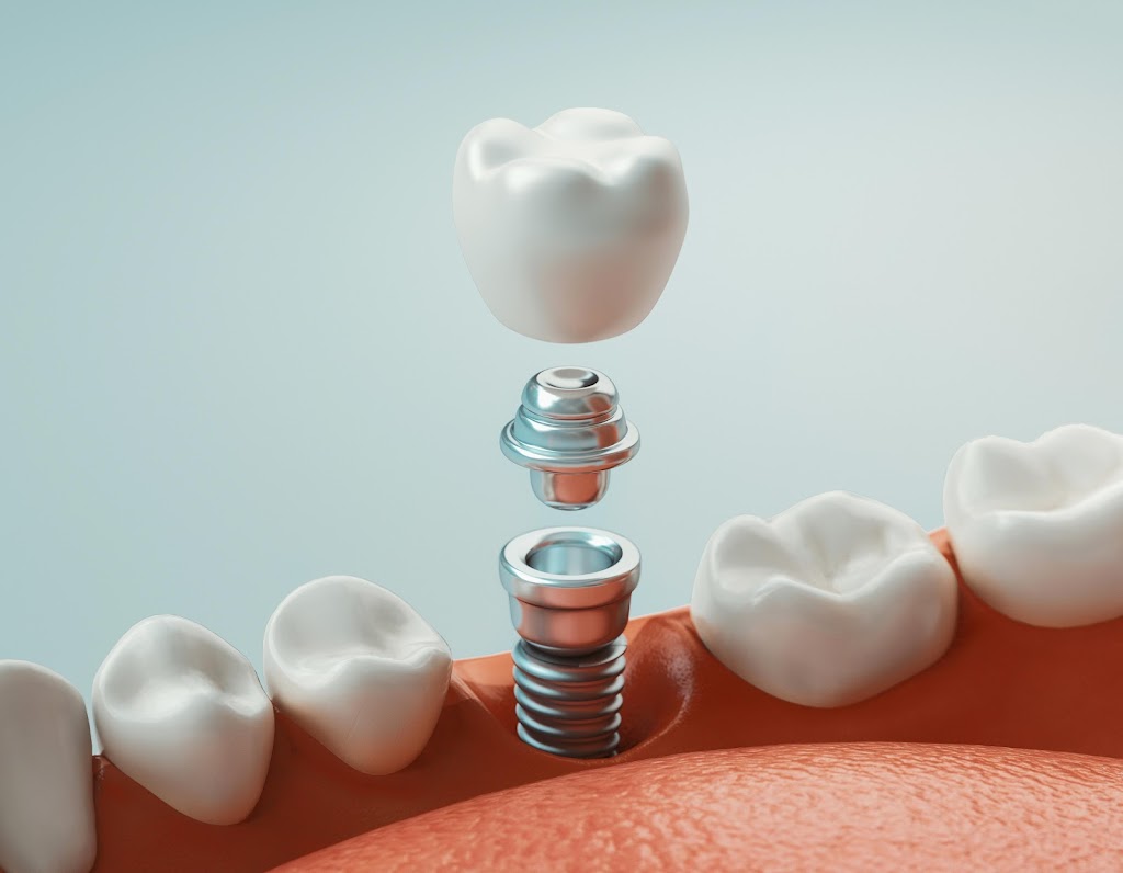 Image for Apex Implant Center with ID of: 7038984