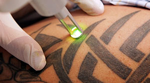 Image for Beloved Laser with ID of: 713478